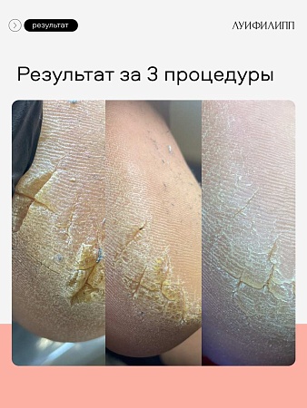Пилинг для кожи стоп LUI PHILIPP COSMETICS Foot peeling, 100 мл (М)